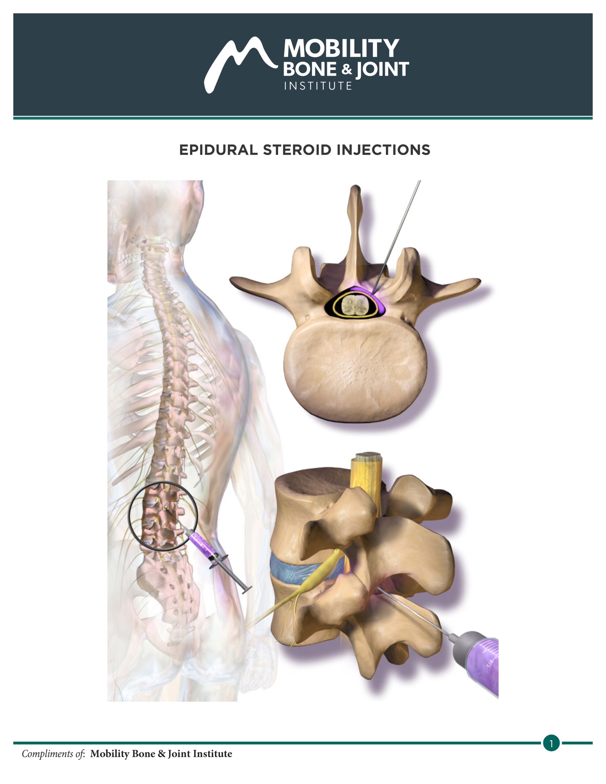 EPIDURAL STEROID INJECTIONS